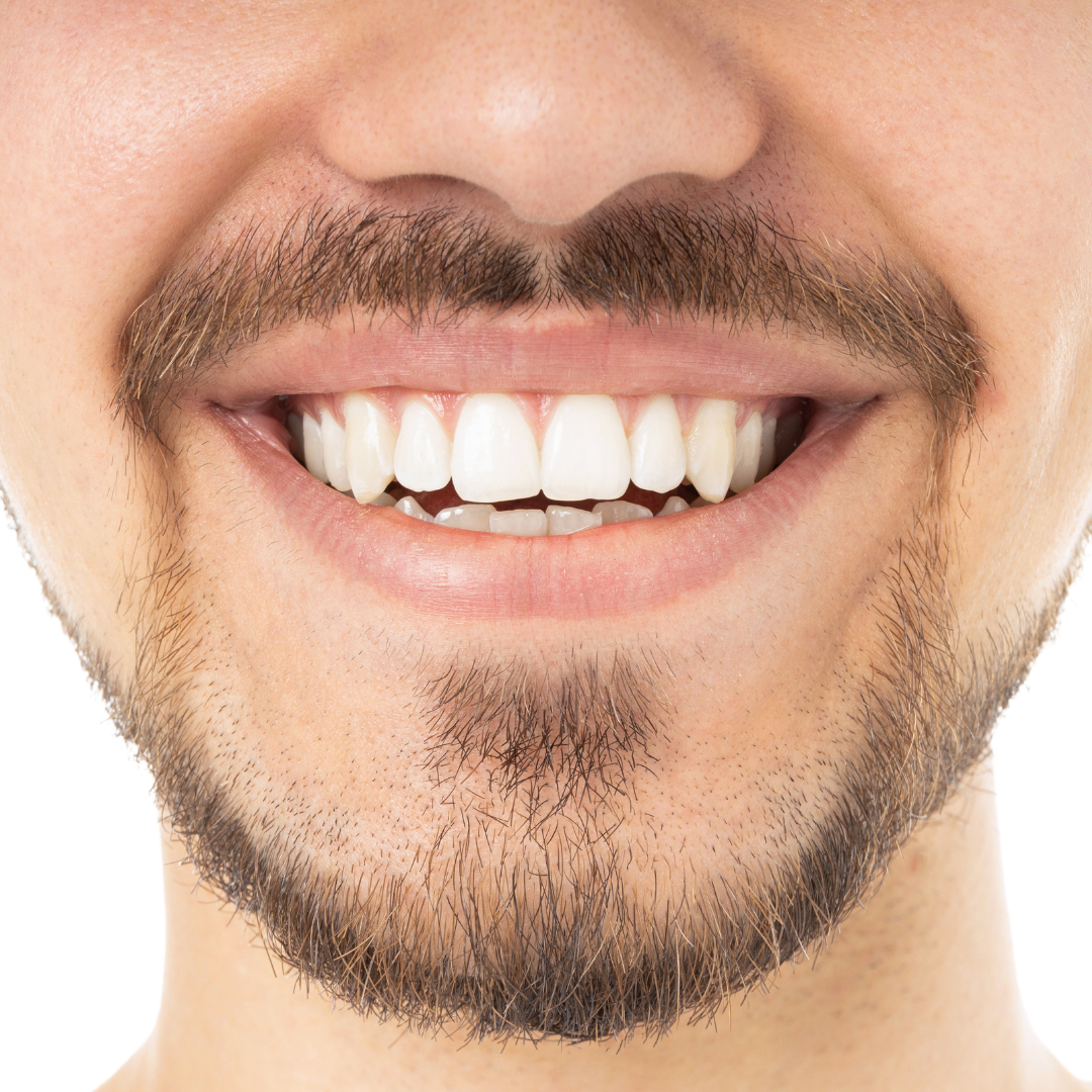 Gummy Smile treatment