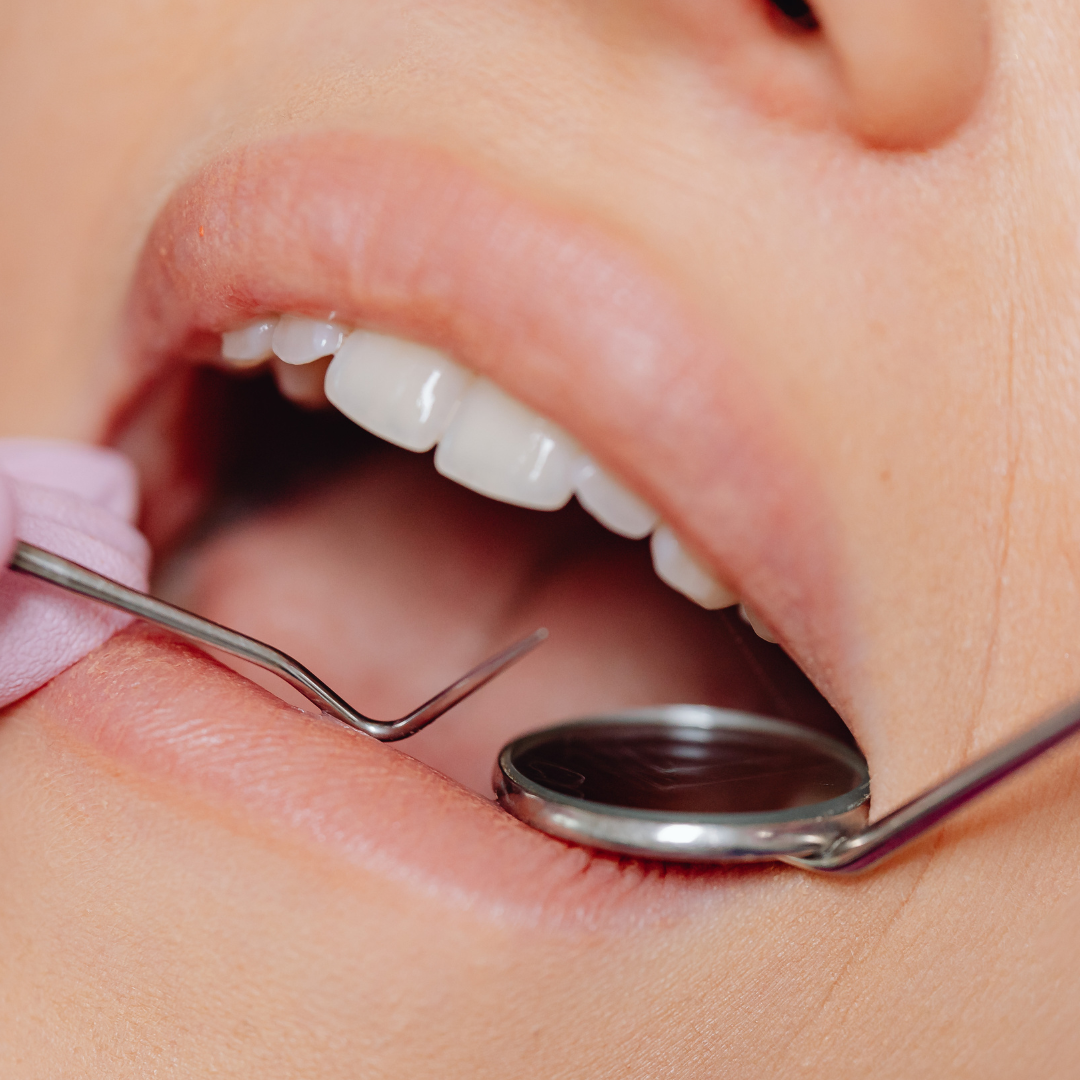 Tooth Filling Farmingdale, NY