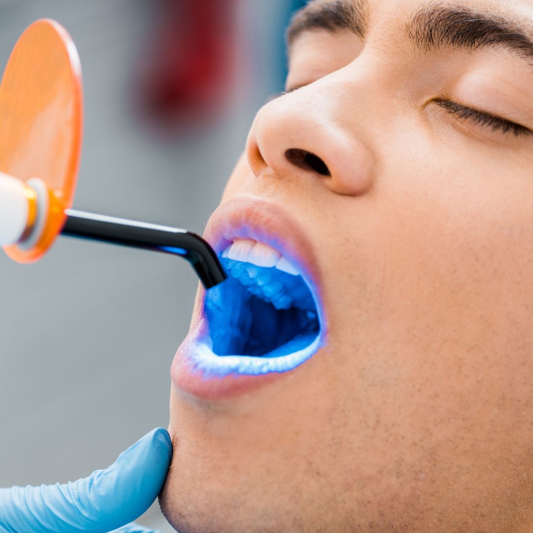 Dental Fluoride Treatment in Farmingdale