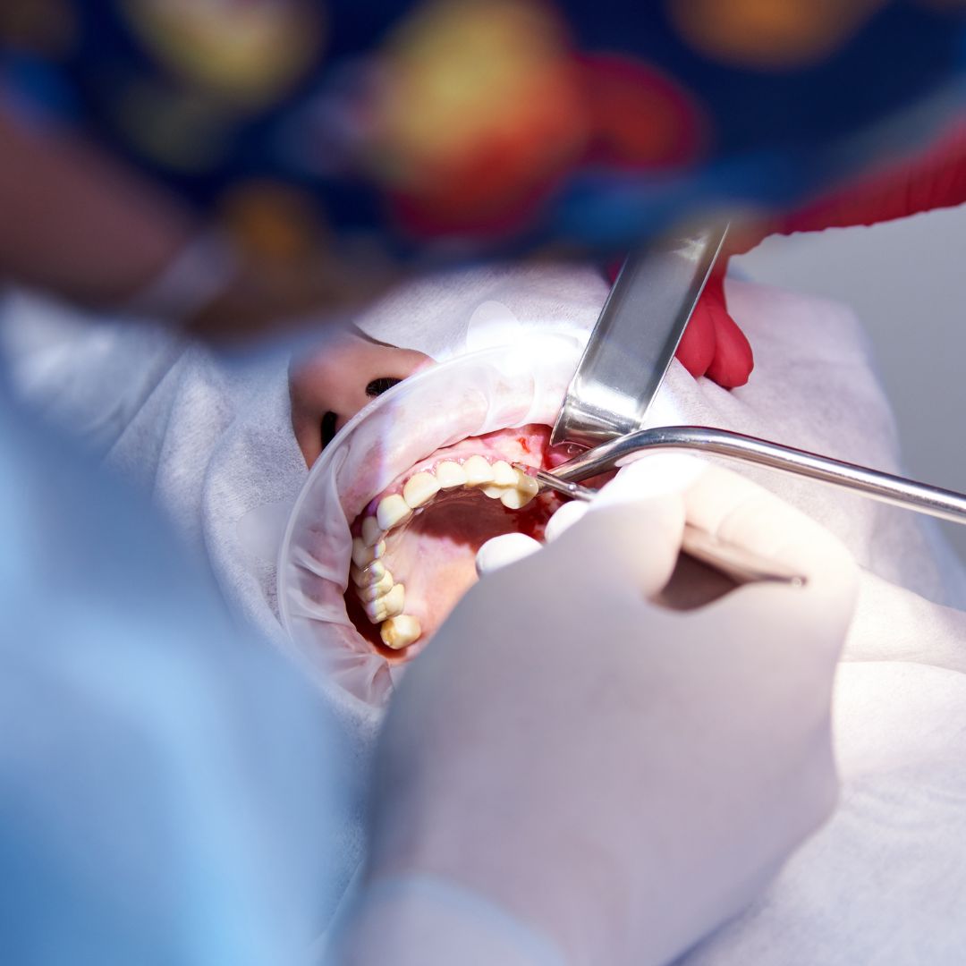 Tooth Extraction in Farmingdale, NY Tooth Extraction in Farmingdale, NY