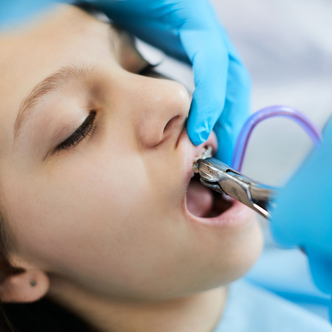 Tooth Extraction in Farmingdale Tooth Extraction in Farmingdale